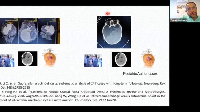 ACNS Webinar - Mar 25 - Pediatric CVJ Anomalies & Pediatric Intracranial Arachnoid Cysts смотреть онлайн