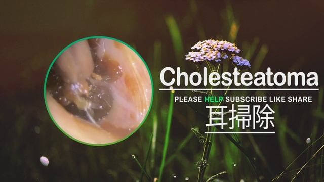 耳垢そうじ , 耳掃除の難聴 最大の耳垢除去[Cholesteatoma] #003 смотреть онлайн