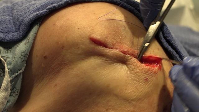3rd Shoulder or Lipoma? | Dr. Derm смотреть онлайн