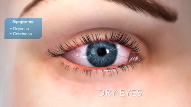 iLux Treatment of Dry Eye Disease смотреть онлайн