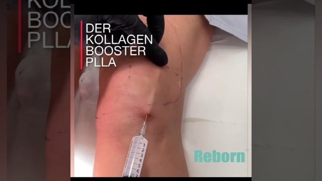 Reborn plla dermal filler for face & neck & legs & buttocks & chest treatments смотреть онлайн