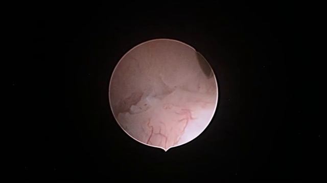 Enucleación de mioma submucoso para resectoscopia y control de la hemorragia uterina. смотреть онлайн