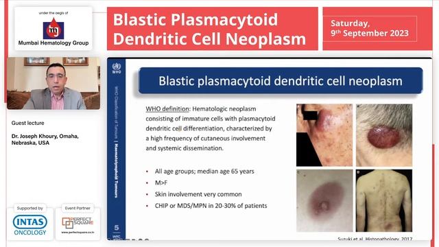 Blastic Plasmacytoid Dendritic Cell Neoplasm смотреть онлайн