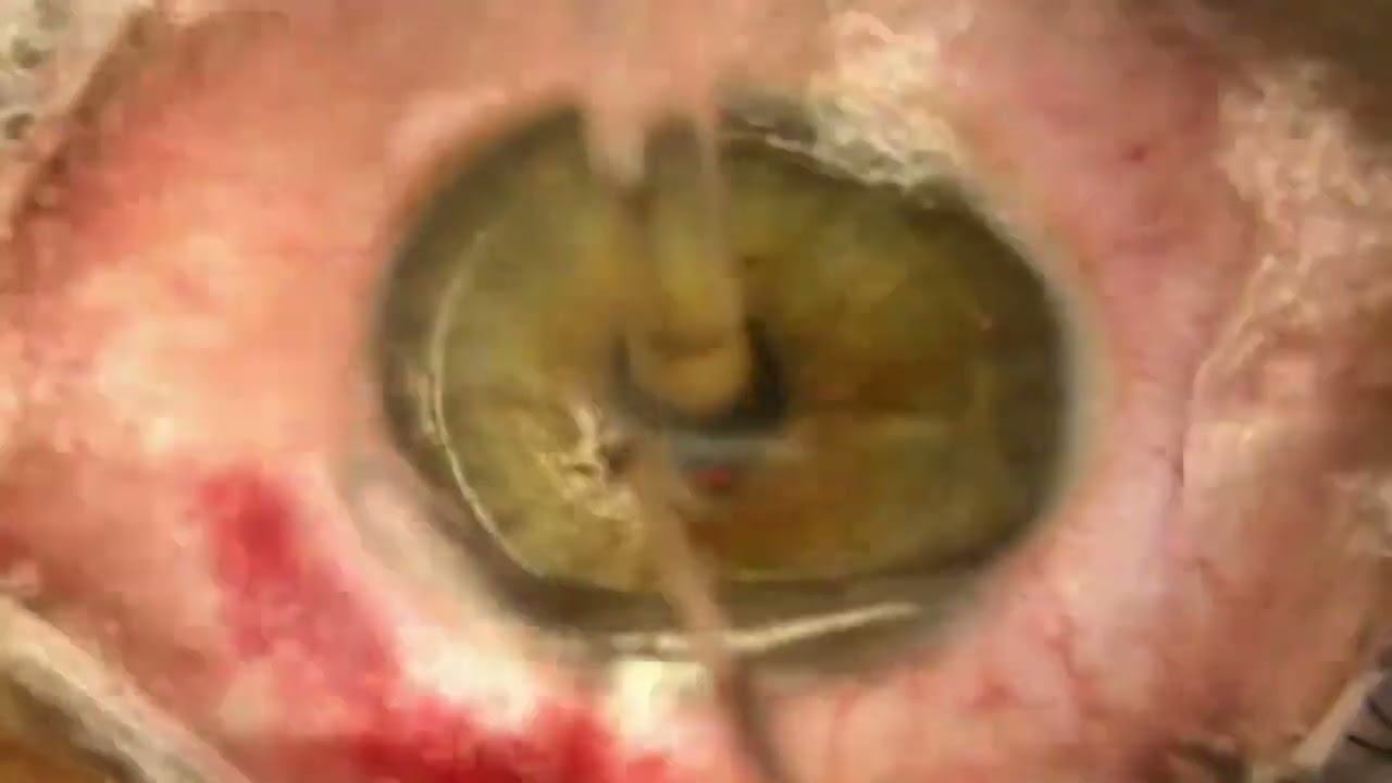 Femto Second Laser with Dr Roopashree Matada смотреть онлайн