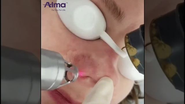 How to treat: Cherry Angioma, Varicose Veins, Acne Rosacea, Spider veins and so on... смотреть онлайн
