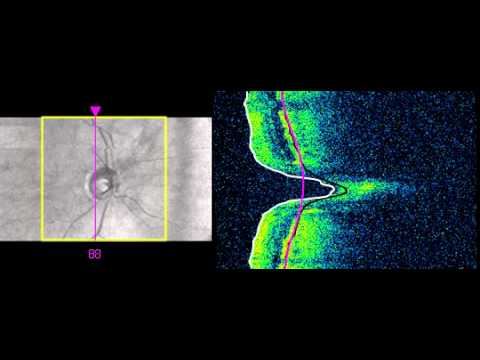 GLAUCOMA DISK DEEP excavation slide смотреть онлайн