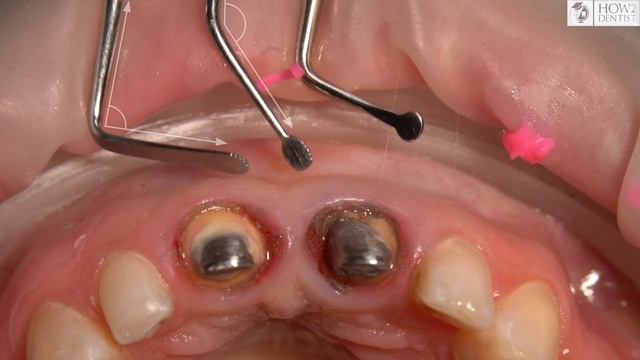 Как выполнить ретракцию / How To Dentist