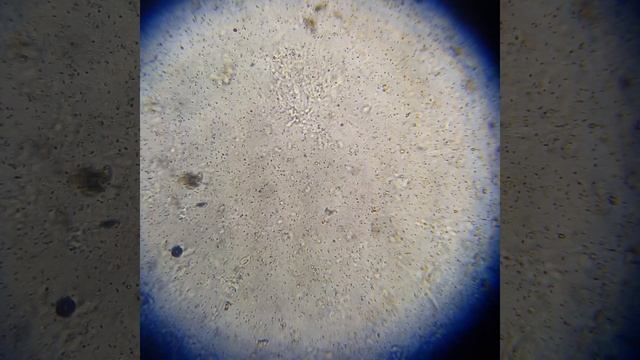 Sperm under microscope 15 months post vasectomy reversal смотреть онлайн