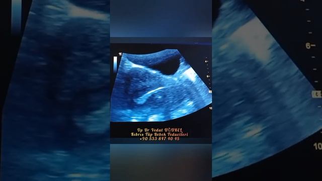 3. ardarda + pozitif sonuç aldığımız hastamız.🐞👼🤰🤲+905338474045 смотреть онлайн