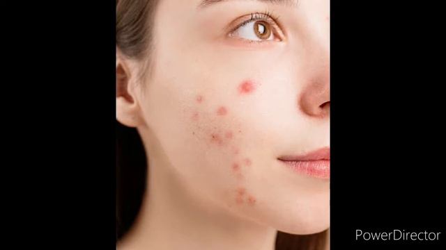 Melamet Cream Uses In Telugu|best Cream For The Melasma