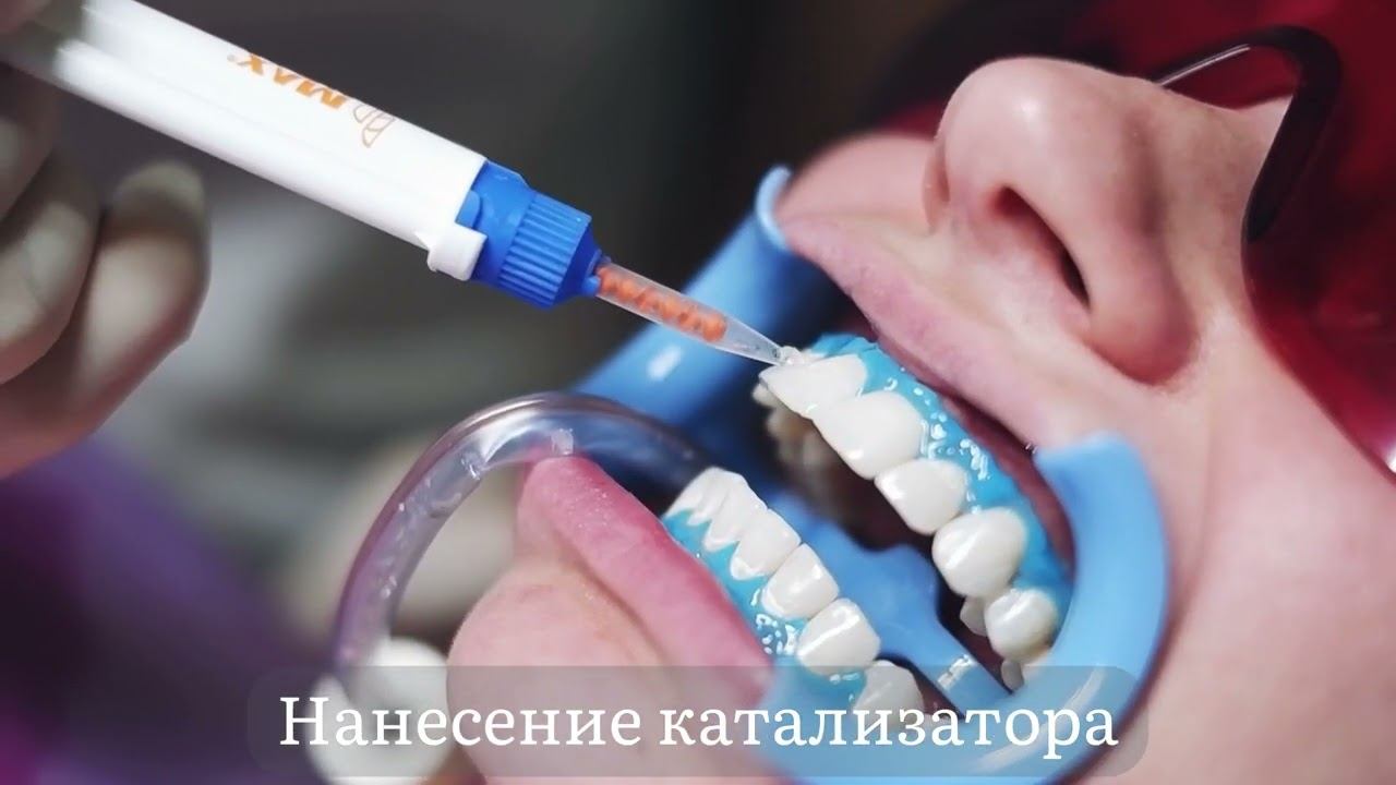 Профессиональное отбеливание зубов Beyond смотреть онлайн