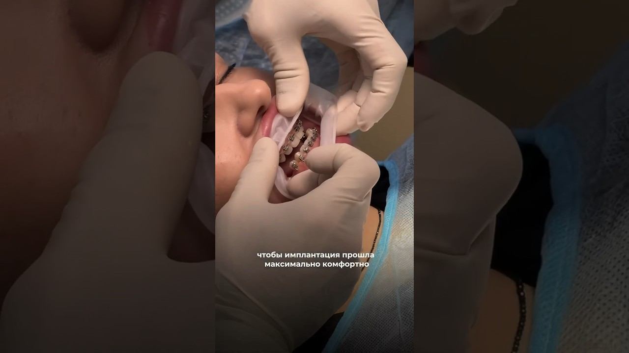До 31.03 имплантация под ключ от 44.990₽, подробнее в инст (по ссылке в описании) #имплантациязубов смотреть онлайн