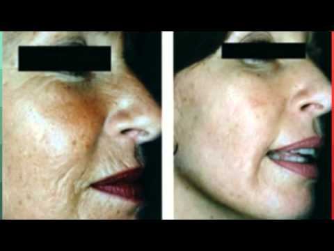 Ageless Derma anti aging intensive skin brightener review смотреть онлайн