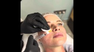 БИОРЕПАРАЦИЯ NOVACUTAN S BIO. Описание и техника проведения