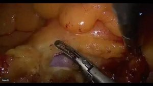 Говорит и показывает П.В. Царьков: удаление 253 группы лимфоузлов