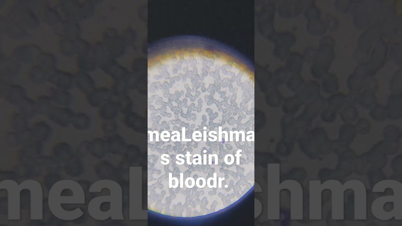 Leishman's stain of Blood smear in SJMCH, puri haematology lab🩸🩸.#sjmchannel #mbbs #haematology смотреть онлайн