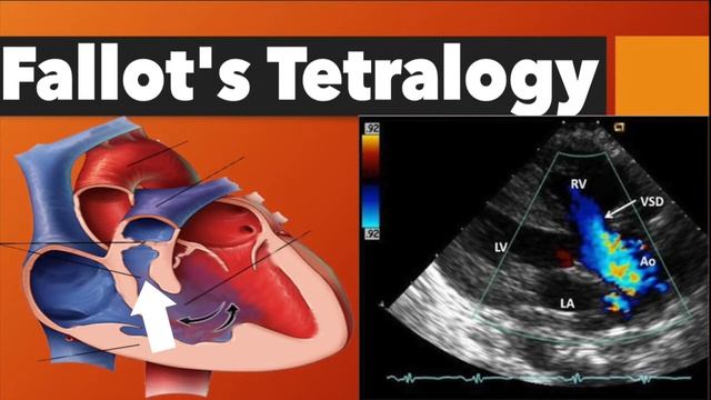 Hypertrophic cardiomyopathy and Congenital diseases смотреть онлайн