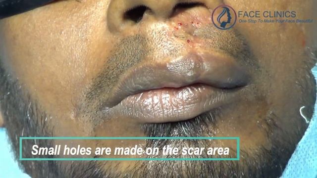 Moustache FUE Hair transplant at Face Clinics Banjara Hills смотреть онлайн