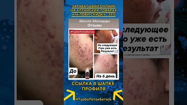 Прыщи. Масло монарды / Батэль Отзывы