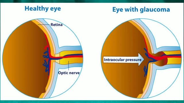 Timolol maleate eye drops ip 0.5 w/v | timolol eye drops | iotim eye drops uses in hindi смотреть онлайн