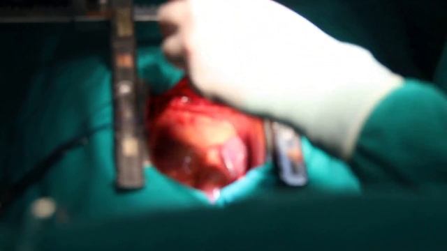 Cirurgia Cardíaca 2