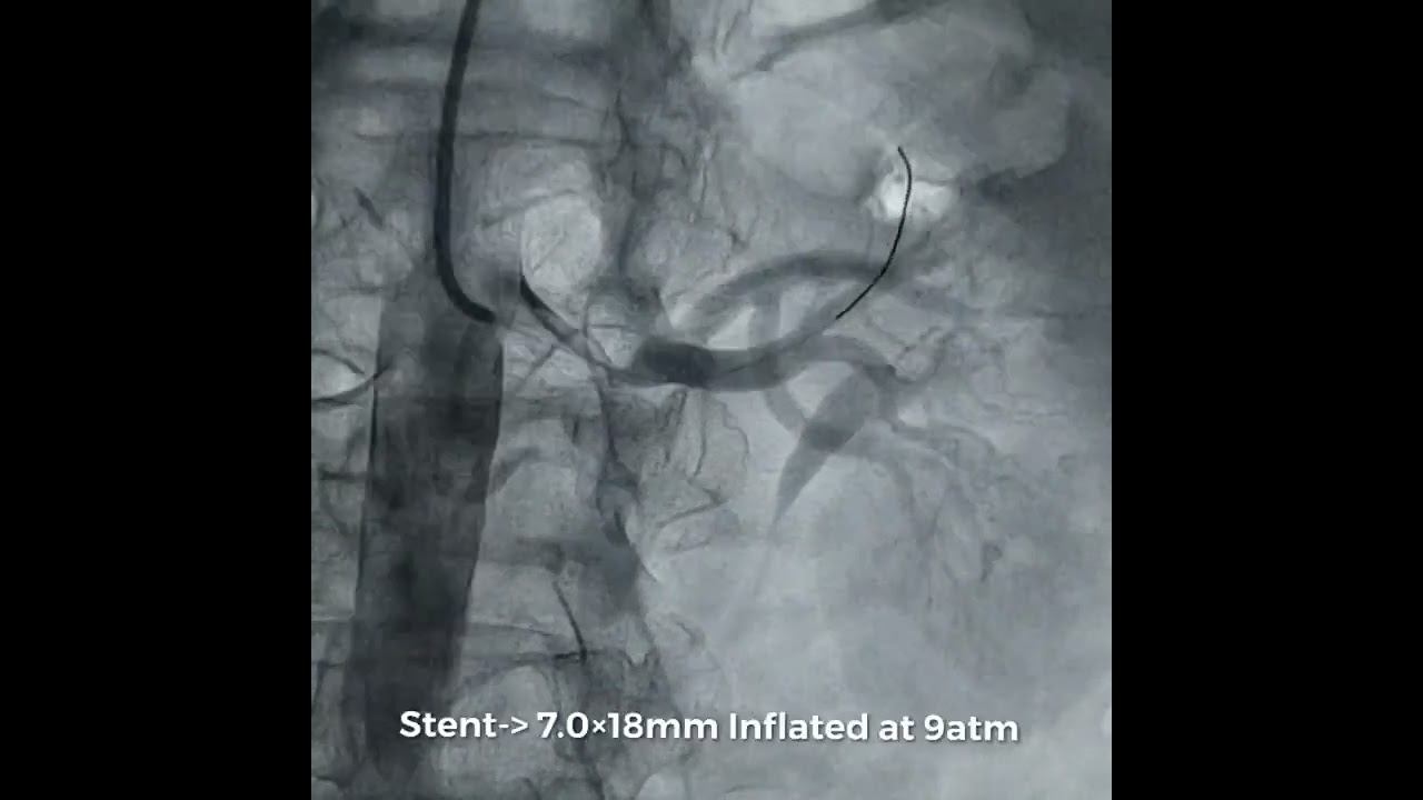 Angioplasty of Left Renal artery смотреть онлайн