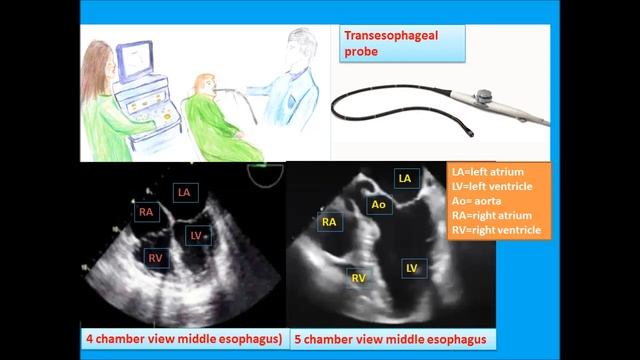 A simple transesophageal echocardiography quiz and introduction to TEE views (TOE) смотреть онлайн