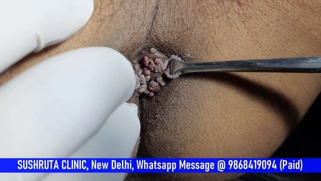 Anal Warts смотреть онлайн