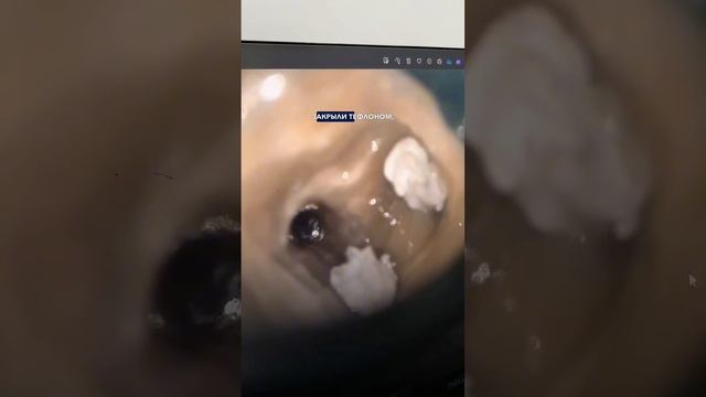 Можно ли спасти зубы после неудачного лечения? Перелечиваем зубы после другой клиники смотреть онлайн