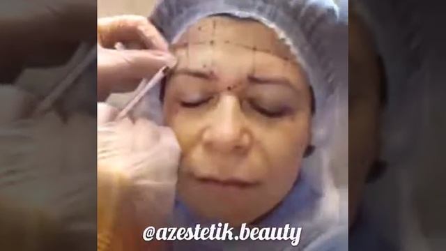 Botulinoterapiya (botox) alın,göz ətrafı qaş arası. смотреть онлайн