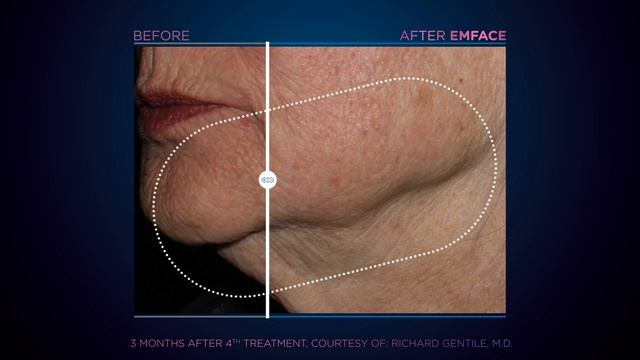 EMFACE Treatment Results