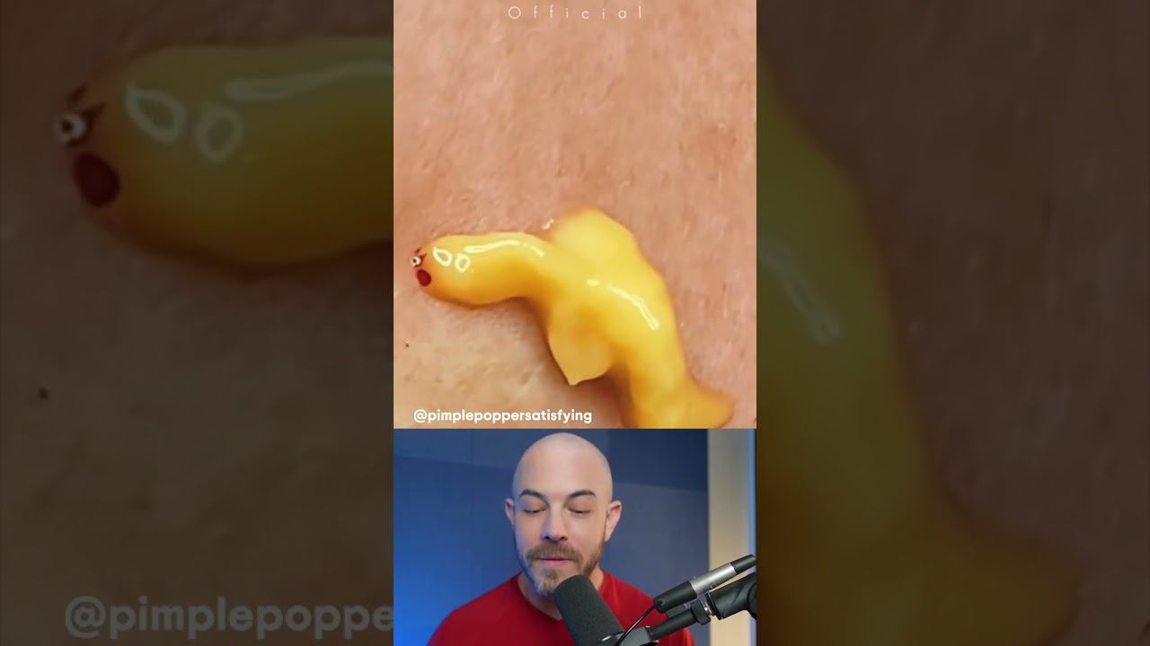 Egg yolk cyst pop! #dermreacts #doctorreacts #yolkpop смотреть онлайн