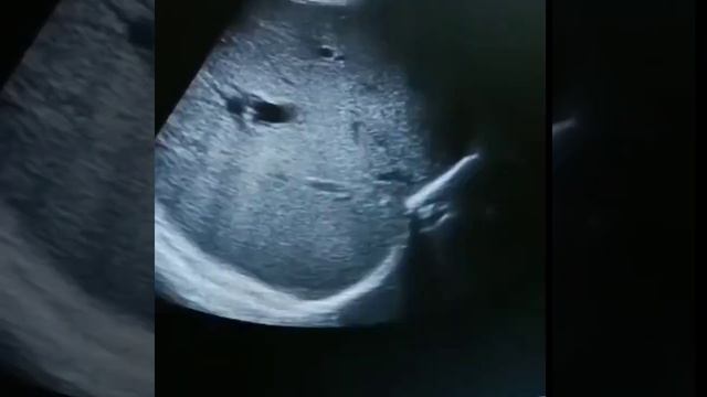 hepato biliary stone смотреть онлайн