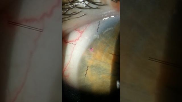Acute Glaucoma смотреть онлайн