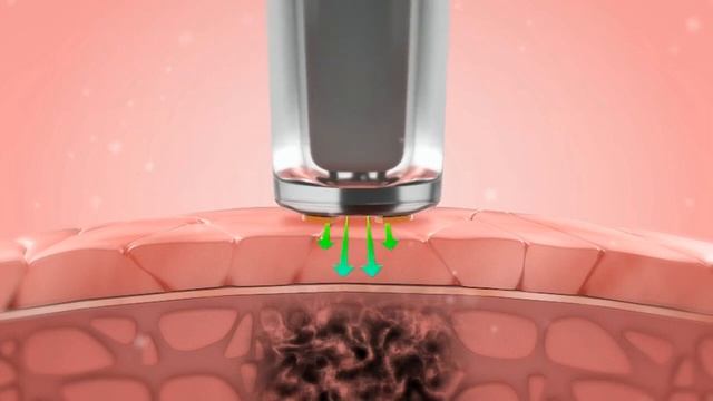 TruScreen скрининг шейки матки смотреть онлайн