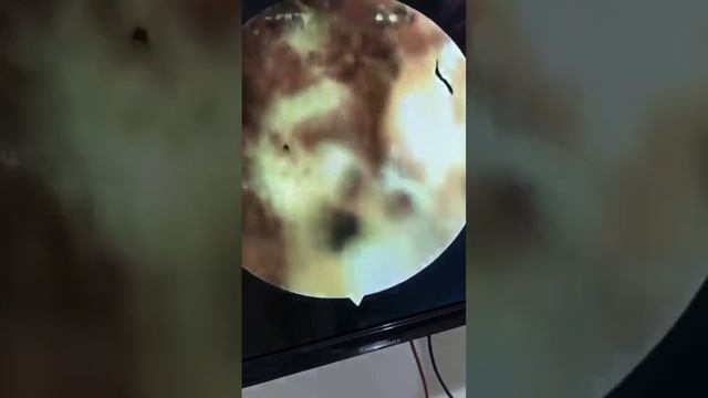 فطريات الأذن (فطر عيش الغراب ) Otomycosis Of External Auditory Canal Cause Severe Pain And Itching