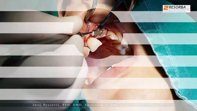 Collagen Membrane PARASORB Resodont Forte смотреть онлайн