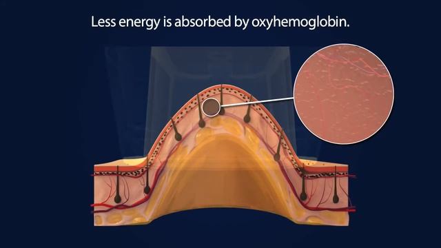 Depilação a Laser - Light Sheer Duet | ABCorps - Emagrecimento e estética смотреть онлайн
