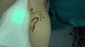 Минифлебэктомия