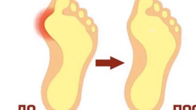 Валгус Про Форум смотреть онлайн