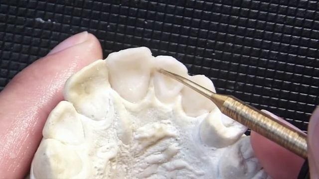 Dental Wax Up: Teeth 21-23 [Part 1 Of 2] - Comprehensive Waxup Tutorial
