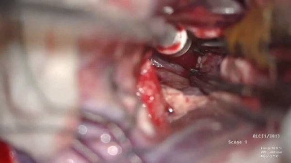 LEFT TRIGONAL INTRAVENTRICULAR NEURONAL TUMOUR