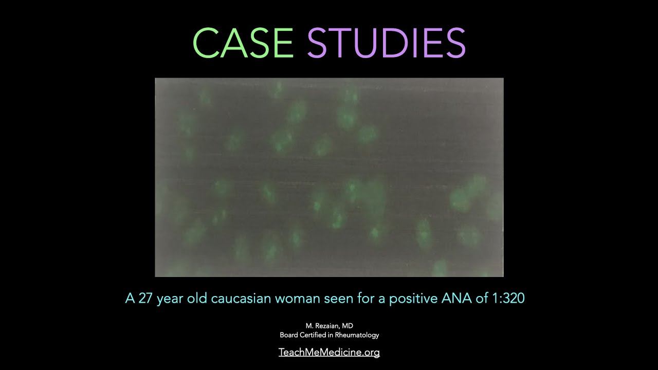 Case Studies: A 27 year old caucasian woman seen for a positive ANA test of 1:320 смотреть онлайн