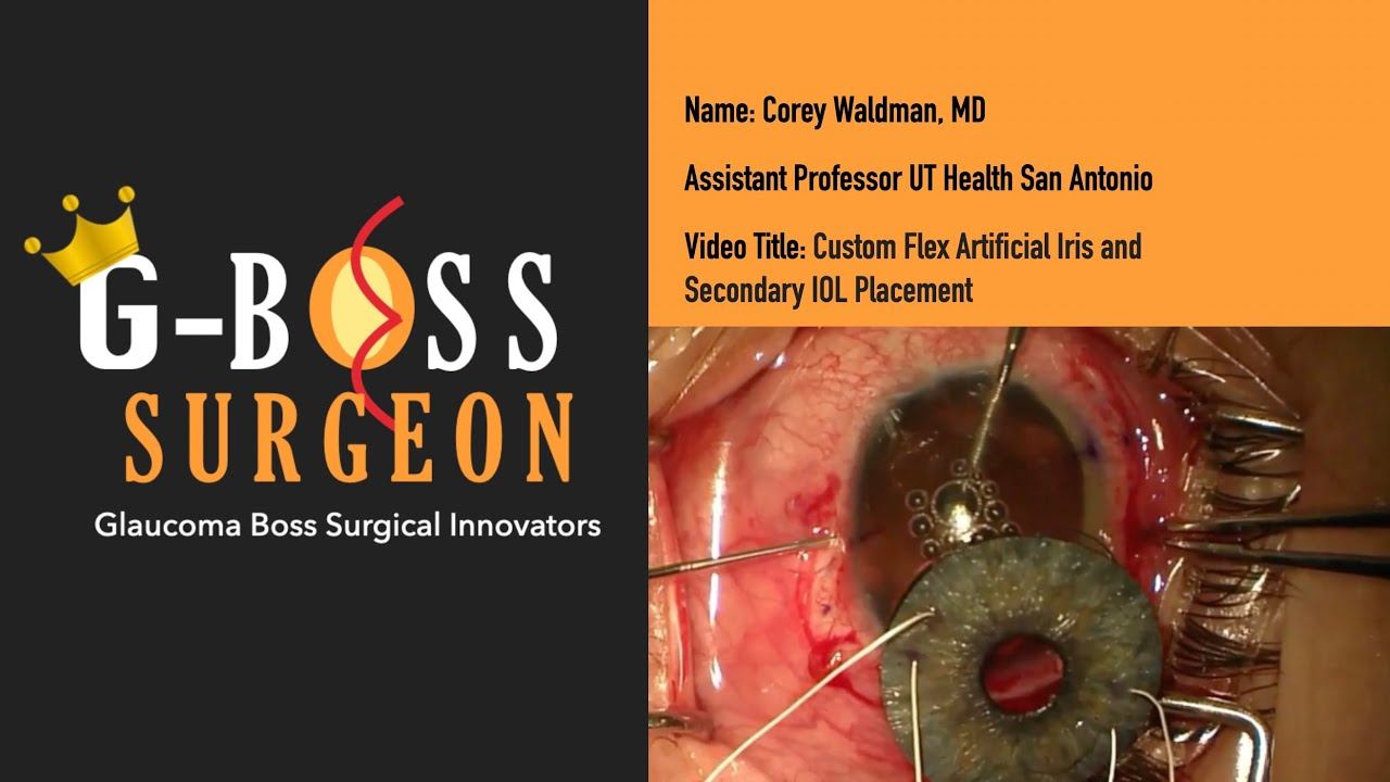 Glaucoma Boss Surgical Innovators Part 3: Custom Flex Artificial Iris & Secondary IOL Placement смотреть онлайн