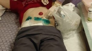 Стома. Замена калоприемника.