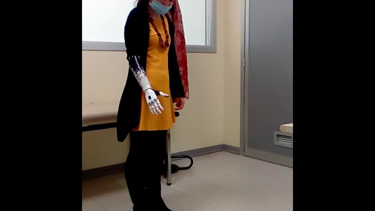 PROTESI D'AVAMBRACCIO PERSONALIZZATA ARTE ORTOPEDIA CON MANO BE-BIONIC смотреть онлайн