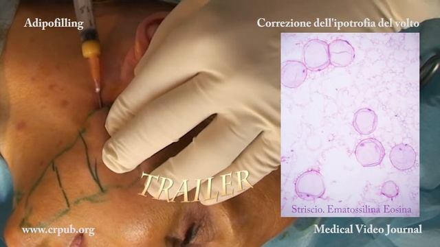 02. Correzione dell’ipotrofia del volto con l’Adipofilling смотреть онлайн