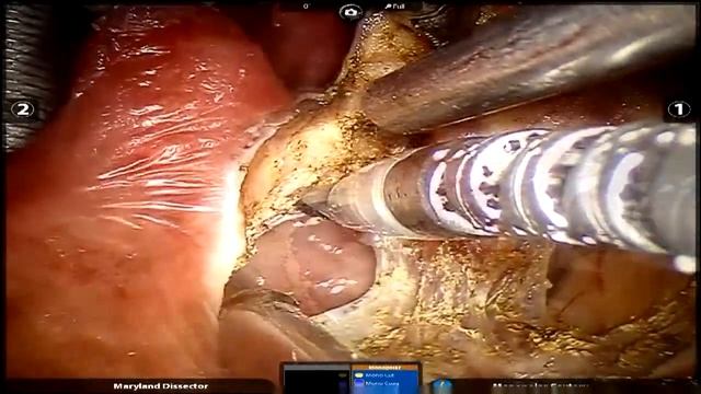 TORS Lateral Oropharyngectomy - Surender Dabas- OM 5.0 (ONCO SURGERY MASTER COURSE) смотреть онлайн