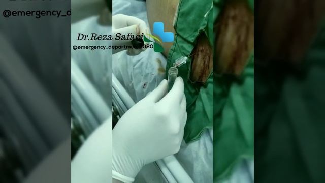 Lumbar Puncture In Patient Suspect To Meningitis  #drrezasafaei