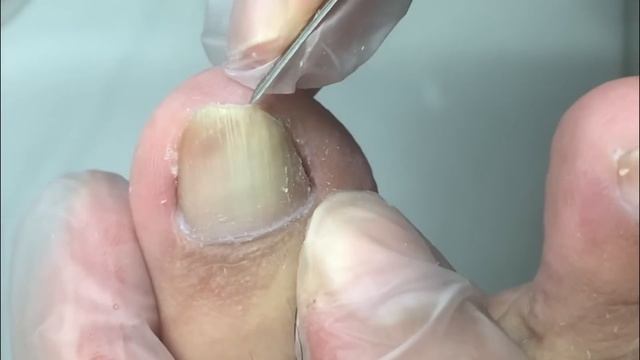 Nails That Grow Into The Flesh Are Too Hard, Trim Them Quickly【DrZhang】